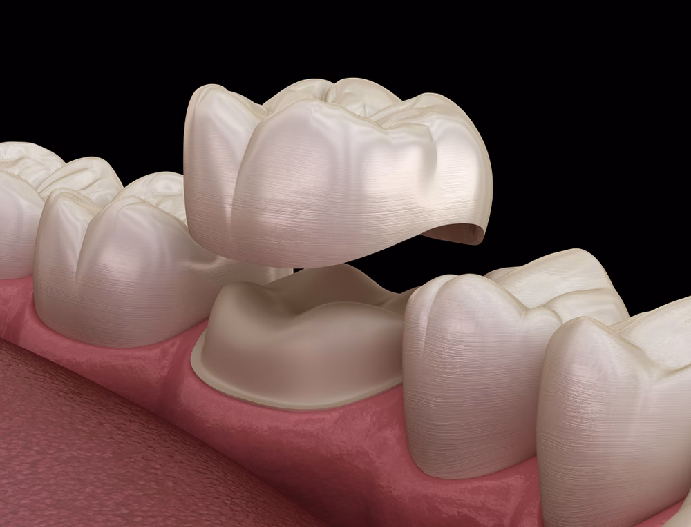 3D illustration of a dental crown fitting over a prepared tooth, with natural teeth and gums, on black. Whiteman Dental Associates.